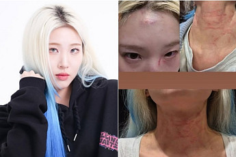 롤링쿼츠이 최현정, 행인과 시비⋯상처 사진에 소속사 측 해명