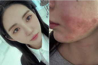AOA 출신 권민아,  피부 시술 중 화상 피해⋯