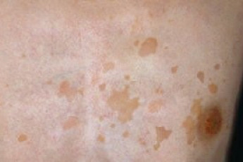 여름철 어루러기 주의보, 알고보니 피부 곰팡이…남성이 두 배 많은 이유는?