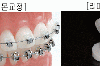 치아, 급속교정과 라미네이트의 차이