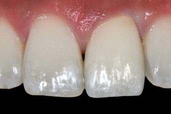 [장수건강 치아에 달렸다 Part 5] 더 진짜 같은 <b>가짜</b> 치아의 세계