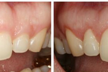 잇몸미소 콤플렉스, 여성이 치료에 적극적