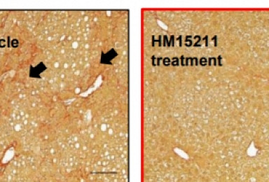 한미약품 랩스커버리 '당뇨병→NASH, 희귀질환' 확대