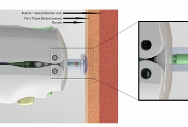 제넥신-美파마젯, ‘needle-free DNA치료백신’ 개발협력
