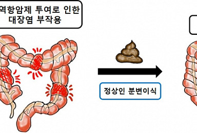 면역항암제 부작용 대장염, 분변이식으로 치료 “첫 사례”