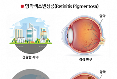 올릭스, 망막색소변성증 RNAi 신약 개발..