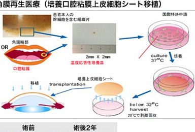 오사카대, 'iPSC 유래 각막조직' 최초 이식..