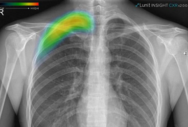 루닛, 폐 질환 검출 AI ‘루닛 인사이트 CXR 2’ 식약처 허가