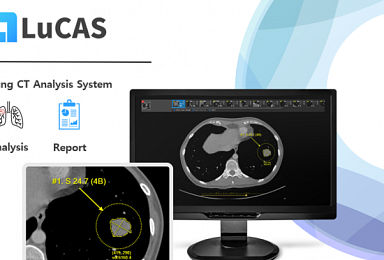 모니터코퍼레이션, AI '흉부CT 진단보조' 식약처 3등급 허가