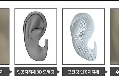티앤알바이오팹, '귀 재건용 인공지지체' 환자에 이식