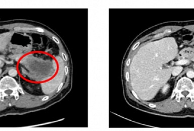 젬백스 리아백스주, 말기췌장암 환자서 '종양감소 효과' 확인