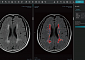 제이엘케이 ‘뇌 백질변성 정량 분석 AI 연구’, 국제 저널 실려