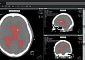 ﻿코어라인소프트, 강북삼성병원에 AI 뇌출혈 진단 솔루션 ‘AVIEW NeuroCAD’ 공급