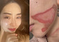 "살이 뜯겨 올라갔다"...AOA 출신 권민아, 시술 후 2도 화상