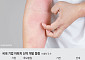 듀피젠트·졸레어 아성 여전…국산 아토피 신약 언제쯤
