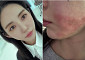 AOA 출신 권민아,  피부 시술 중 화상 피해⋯"합의 제안했다가 협박범으로 몰려"