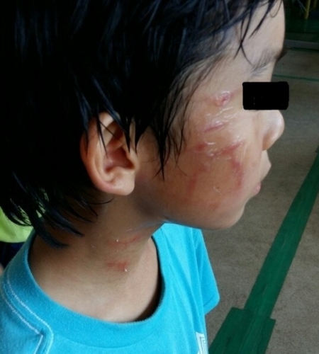 ▲김병지 선수의 아들이 학교폭력 가해 논란에 휩싸였다. 사진은 피해자의 어머니라고 주장한 게시자가 공개한 피해학생의 모습. (사진=온라인 커뮤니티)