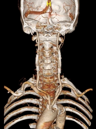 ▲최태현씨의 수술후 3D CT 촬영 사진. 목 부위 혈관에 두드러진 부분이 삽입된 스텐트다.(브라보마이라이프)