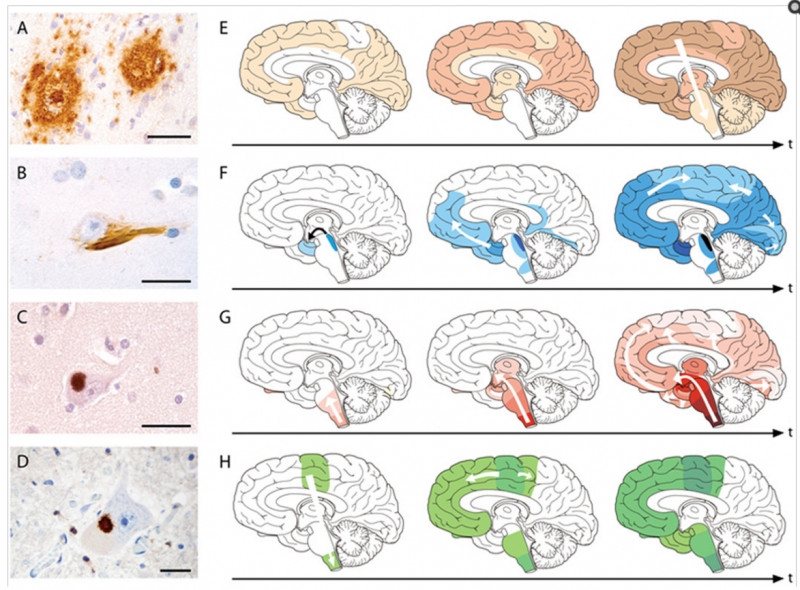 ▲출처: Jucker M, 2013, Nature, Figure 1에서 가져옴