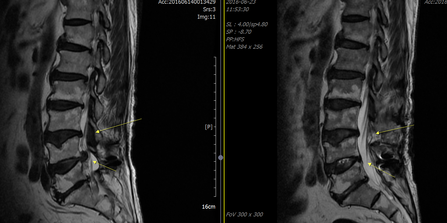▲척추관협착증 수술 전(좌)과 수술 후(우)의 MRI 촬영사진. 눌려있던 신경이 펴진 것을 확인할 수 있다.
(서울바른세상병원)