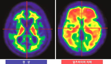 ▲아밀로이드 PET-CT로 진단한 정상인과 치매 환자의 진단 영상. (국제성모병원)