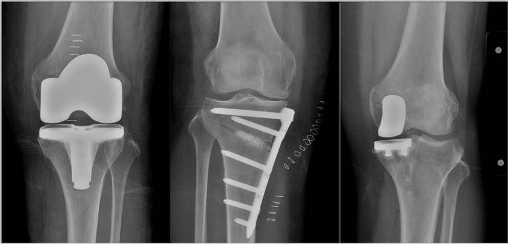 ▲무릎 수술 종류에 따른 X선 사진 모습. 좌측부터 인공관절 전치환술, 근위경골 절골술, 인공관절 반치환술. (국제성모병원)