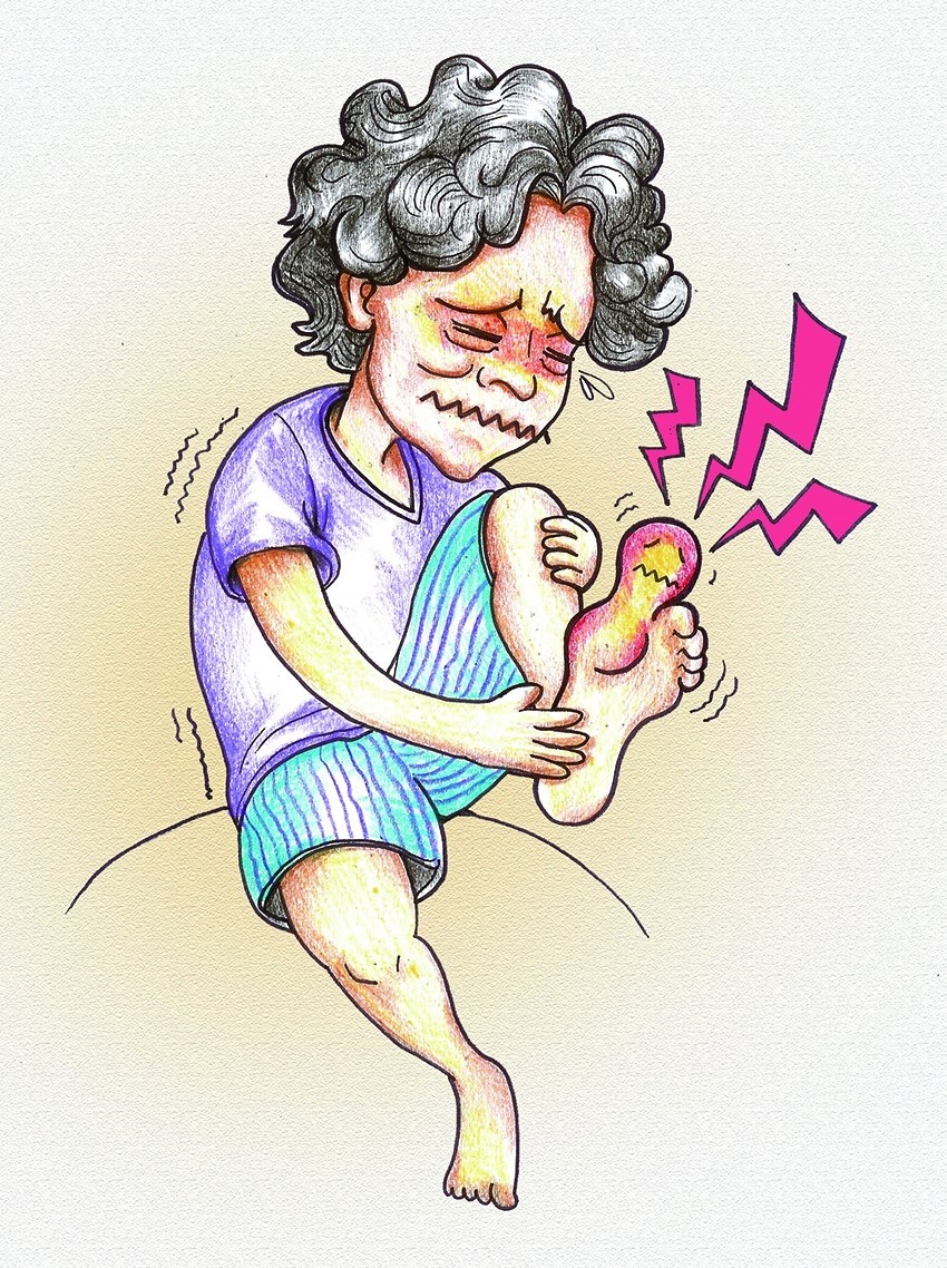 ▲통풍성 관절염은 엄지 발가락 부위에서 주로 나타나지만 무릎, 고관절, 어깨, 손목 등 모든 관절에서 발생할 수 있다.(브라보 마이 라이프)