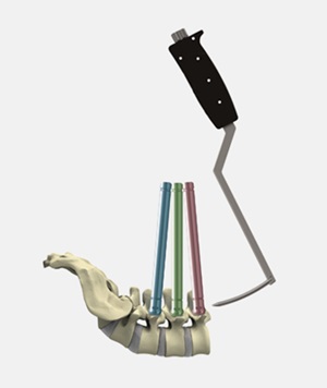 ▲솔고바이오의 척추 임플란트 Extended Long Arm screw(사진제공=솔고바이오)