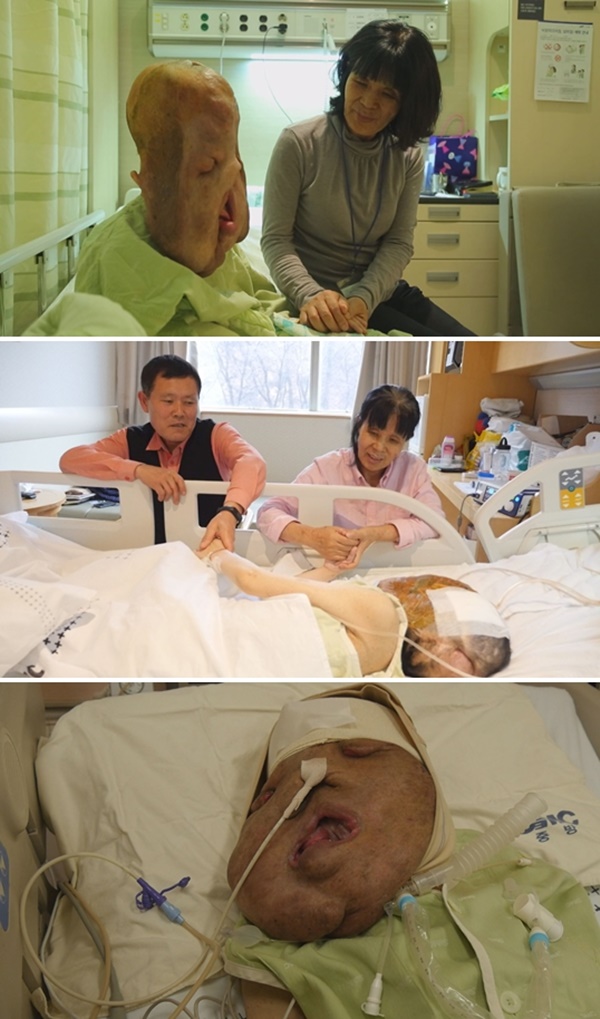 ▲'세상에 이런일이' 신경섬유종을 앓던 심현희 씨(사진=SBS)