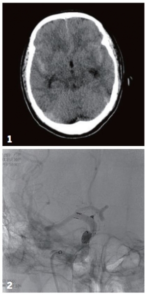 ▲1 회색 뇌실질을 따라 하얗게 보이는 것이 뇌지주막하 출혈로 최초 내원시 촬영된 뇌 CT 사진. 2 미세 카테터를 이용해 코일을 박리성 뇌동맥류에 삽입하여 치료하는 장면. (인천성모병원)
