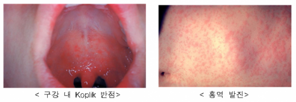 ▲홍역 증상인 코플릭 반점과 발진.(미국질병관리본부(Centers for Disease Control and Prevention) )