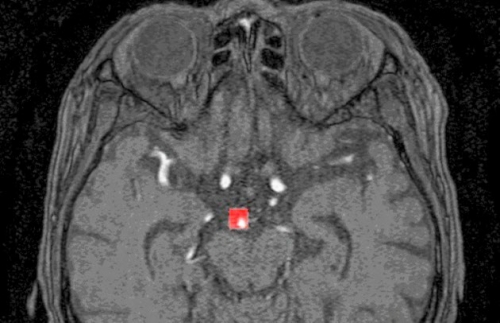▲일본 스타트업 엘픽셀의 AI가 MRI 이미지에서 뇌동맥류를 표시하고 있다. 사진 제공=엘픽셀
