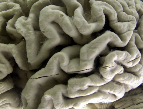 ▲미 뉴욕주 버팔로의 버팔로대학 신경해부박물관에 알츠하이머병에 걸린 뇌의 일부가 전시돼 있다. 버팔로/AP뉴시스
