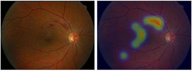 ▲기본 안저검사 사진(좌)과 알고리즘이 판단한 출혈 병변 부위(우)(분당서울대병원)