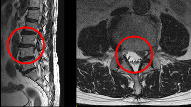 ▲허리디스크(연세건우명원)