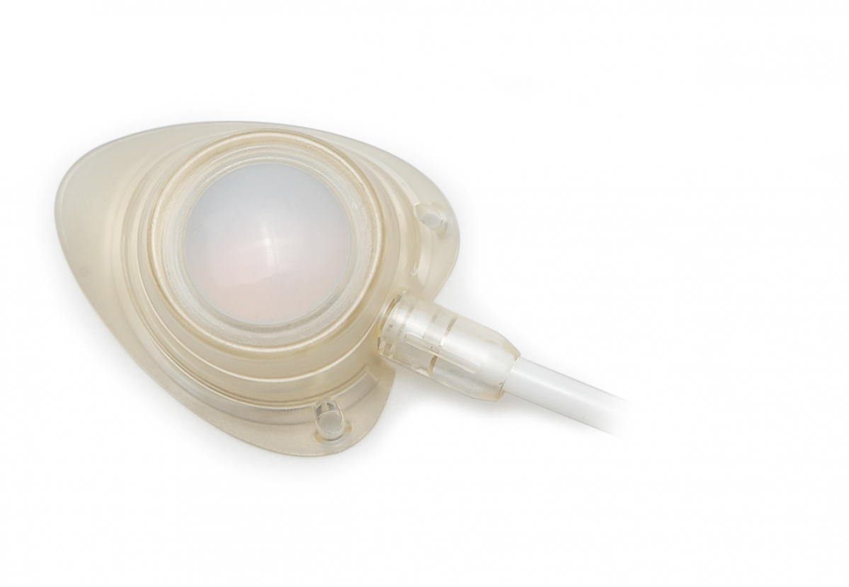 ▲케모포트(상표명 튤립포트)는 주사 오류를 줄이기 위해서 주사 부위인 실리콘 격막을 크게 만들면서도 350psi까지 압력을 견딜 수 있도록 격막과 하우징 사이에 이중 창틀과 유사한 구조를 설계하여 특허를 등록했다. 또한 포트 두께는 얇게 만들고 작은 피부 절개창으로도 시술이 용이하게 하트 모양으로 만들어 환자의 불편을 줄이도록 설계했다. 인체에 장기간 접촉하는 하우징에는 의료용 폴리머 대신 고급 임플란트용 폴리머를 사용하여 환자의 안전을 최우선으로 고려했다. 또한 포트에 빛을 내는 광원을 넣어 피부 밖에서도 약물 주입부를 정확히 눈으로 확인할 수 있는 특허도 보유하고 있다. (메디튤립)