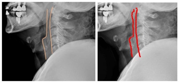 ▲치과 보철치료를  받은 외상환자의  경추 X-ray 영상을 영상의학과  의사가 판독(사진 좌측)한  결과와 AI가 판독(사진  우측)한 결과를 비교했을  때 큰  차이를 보이지  않았다. 엑스레이를  판독할 때  척추 앞  공간을 보기  위해 척추  앞 공간선을  그리게 되는데 AI 역시  의사가 그린  공간선과 같은  모양을 그렸다.(세브란스)