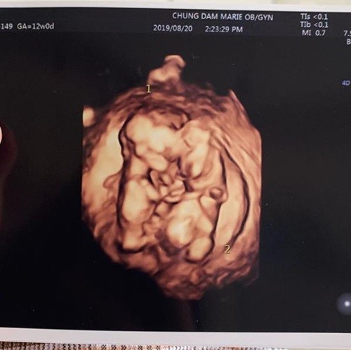 ▲율희가 직접 공개한 쌍둥이 초음파 사진(율희 인스타그램)