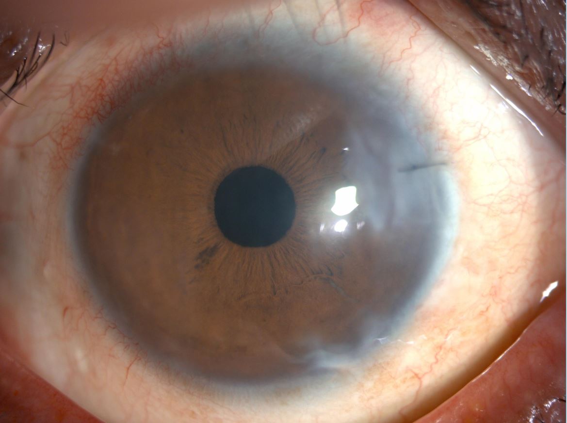 ▲데세메막이식 후60대 환자의 각막(여의도성모병원)