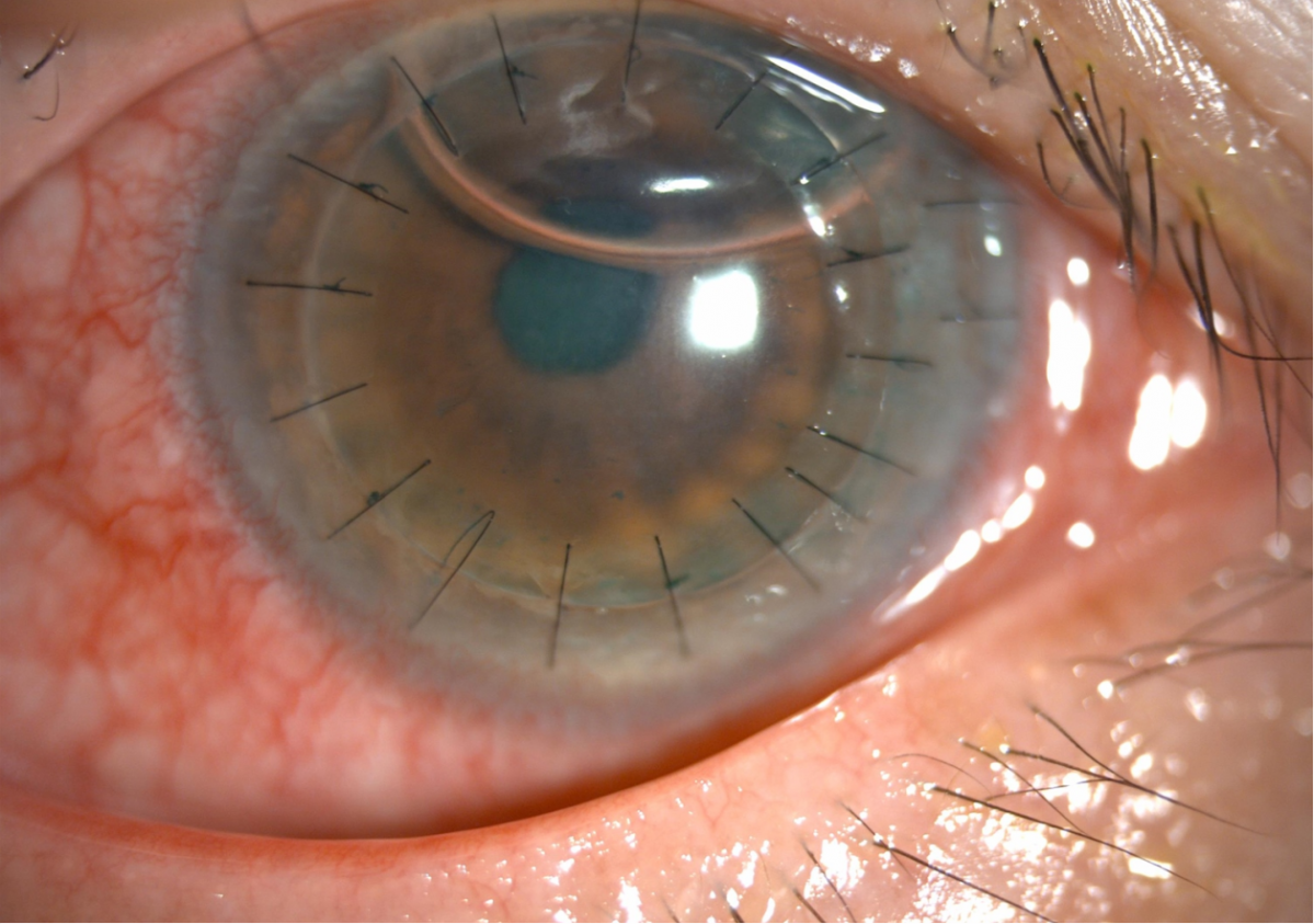 ▲심부표층각막이식후 60대 환자의 각막(여의도성모병원)