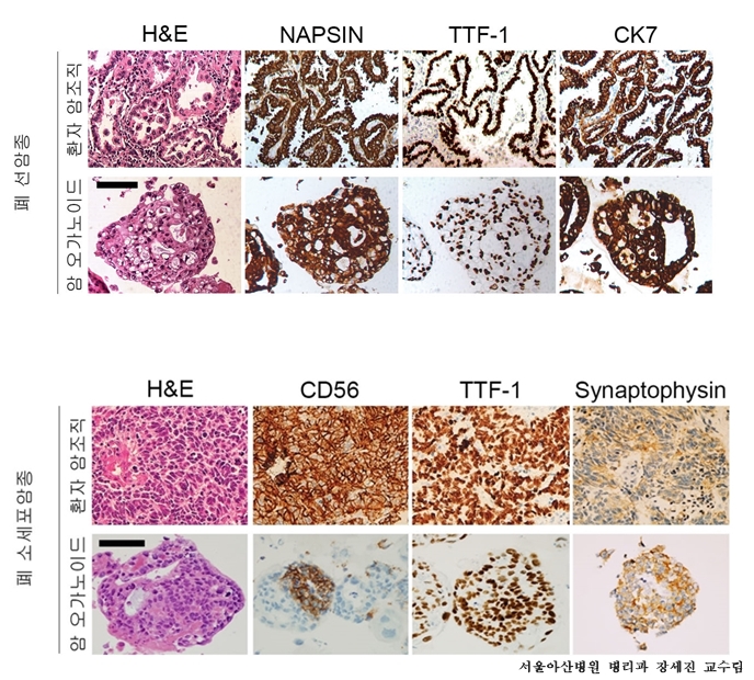 ▲폐암 비소세포암 중 발병 빈도가 높은 폐 선암종과 (서울아산병원)