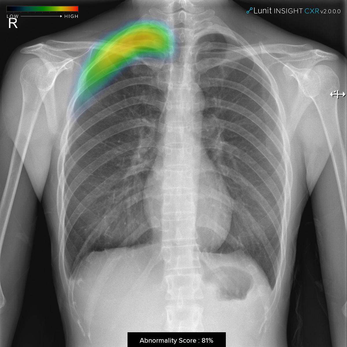 ▲Lunit INSIGHT CXR 2로 검출한 기흉 케이스. 병원에서 사용하는 판독 시스템(PACS)에 탑재되어 판독 환경에 최적화됐다.  (루닛)