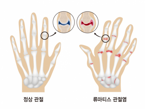 (강동경희대병원)