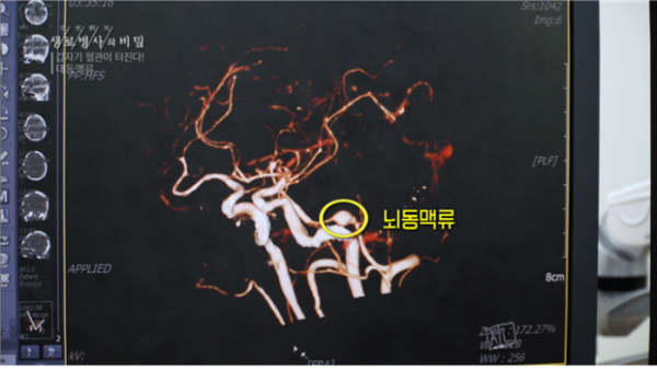 ▲'생로병사의 비밀' 대동맥류(사진제공=KBS1)