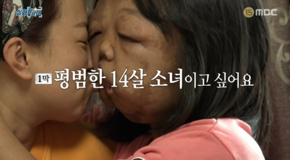 ▲신경섬유종을 앓고 있는 14세 소녀 여진(사진=MBC '실화탐사대' 방송화면 캡처)