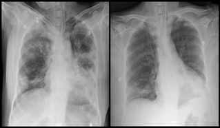 ▲67세 여성 X-ray 사진 (세브란스)