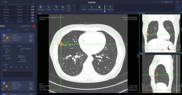 ▲뷰노메드 폐CT AI™ 스크린  (뷰노)