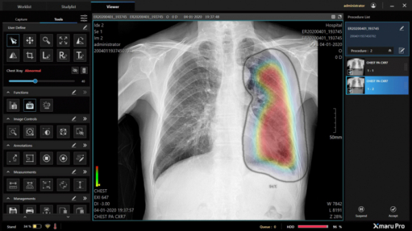 ▲레이언스의 엑스마루 프로가 AI로검출한 폐렴 관련소견 (레이언스)