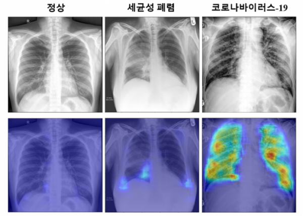 ▲제안하는 코로나19 진단 알고리즘을 통해 얻은 코로나19 확률 분포 특징 지도 사례 (카이스트 제공)