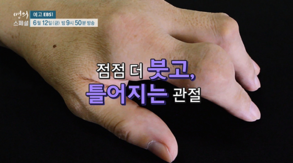 ▲'명의 스페셜' 통풍(사진제공=EBS1)